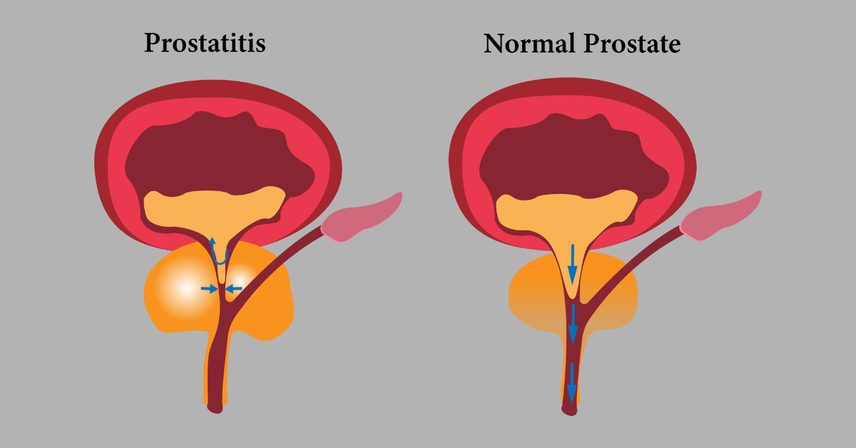 Prostate surgery in Indore, prostate cancer treatment in indore