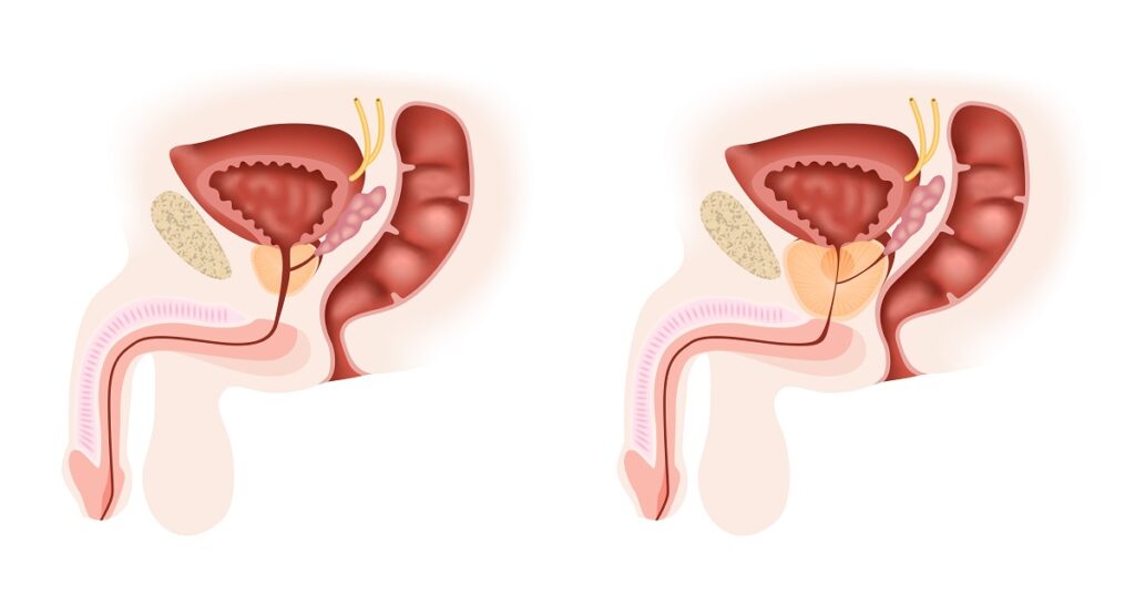 Prostate Surgery: The Role of Age and Health