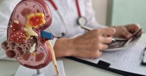 best kidney stone treatment in indore